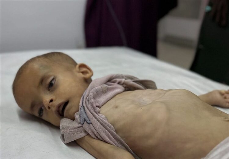 "اليونيسف": 112 طفلًا في غزة يعانون من سوء التغذية يوميًا