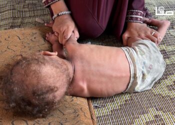 5 وفيات في غزة نتيجة سوء التغذية خلال 24 ساعة